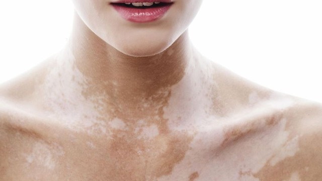 bai-viet/cach-chua-benh-bach-bien-tai-nha-don-gian-va-hieu-qua-59402.html