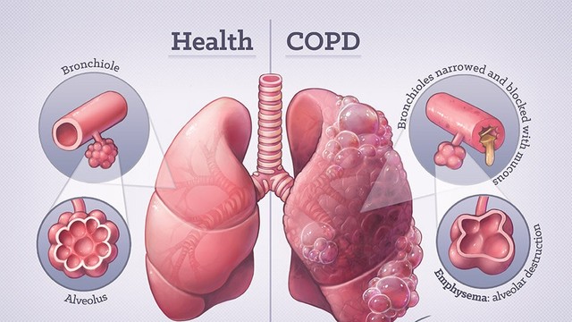 bai-viet/cach-chua-benh-phoi-tac-nghen-man-tinh-hieu-ro-de-ap-dung-hieu-qua.html