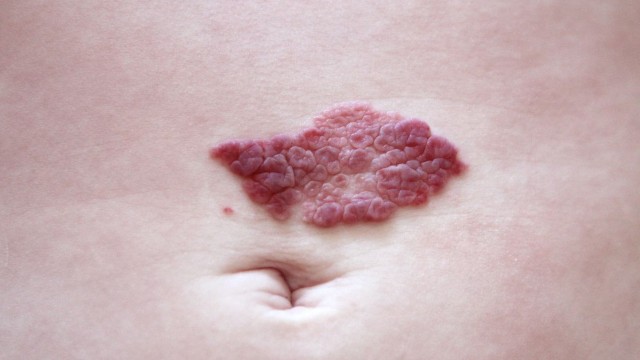 bai-viet/cach-chua-benh-u-mau-o-nguoi-lon-khi-nao-can-can-thiep-va-lua-chon-dieu-tri-phu-hop.html