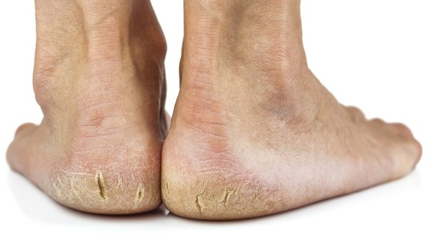 bai-viet/cach-chua-chai-chan-tai-nha-de-ap-dung-khong-lo-tai-phat-65867.html