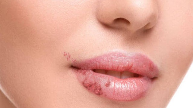 bai-viet/cach-chua-choc-mep-don-gian-ai-cung-lam-duoc-62130.html