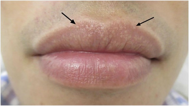 bai-viet/nguyen-nhan-va-cach-chua-dom-trang-tren-moi.html