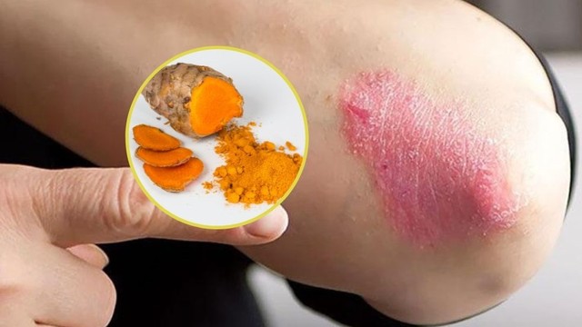 bai-viet/cach-chua-hac-lao-bang-nghe-co-hieu-qua-khong.html