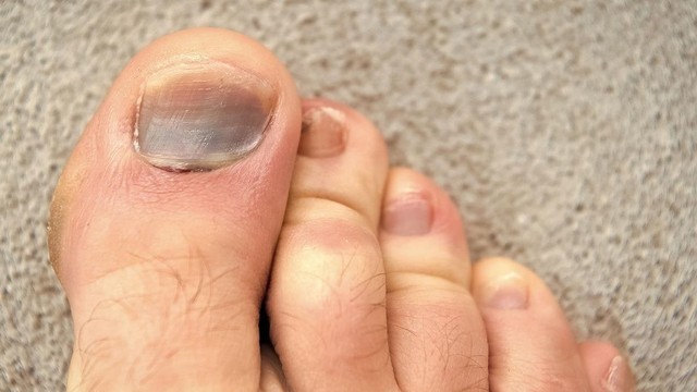 bai-viet/cach-chua-mong-chan-bi-bam-tim-giup-vet-thuong-nhanh-hoi-phuc.html