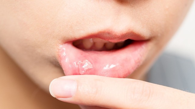 bai-viet/cach-chua-nhiet-mieng-tai-nha-hieu-qua-co-the-ban-chua-biet.html