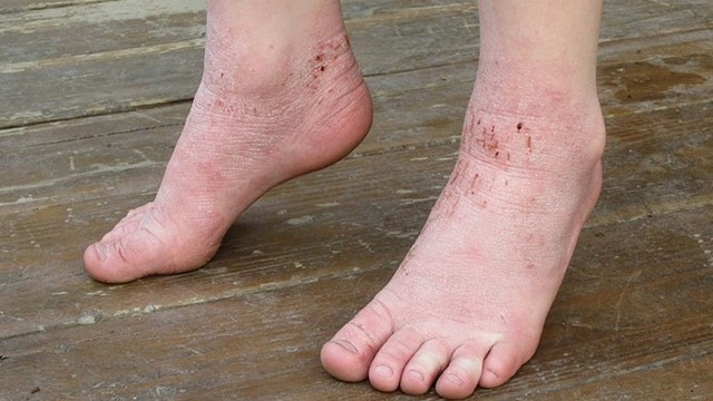 bai-viet/cach-chua-to-dia-cho-ba-bau-an-toan-hieu-qua-62735.html