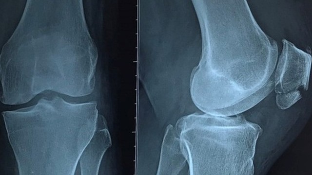 bai-viet/cach-dieu-tri-chan-thuong-gay-xuong-banh-che-do-bac-si-goi-y-54984.html