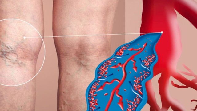 bai-viet/cach-dieu-tri-huyet-khoi-tinh-mach-phuong-phap-hieu-qua-va-an-toan.html