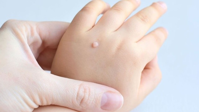 bai-viet/cach-dieu-tri-mun-coc-o-em-be-ma-phu-huynh-nen-biet-59643.html