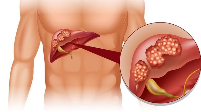 bai-viet/cach-dieu-tri-nang-gan-nhu-the-nao-nhung-luu-y-trong-cach-dieu-tri-nang-gan.html