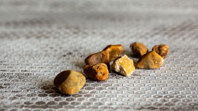 bai-viet/tim-hieu-cach-dieu-tri-soi-duong-mat-trong-gan.html