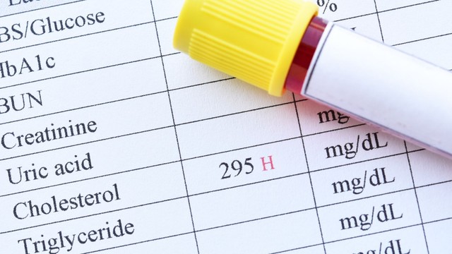 bai-viet/cach-giam-cholesterol-ma-nguoi-co-cholesterol-cao-nhat-dinh-phai-biet.html