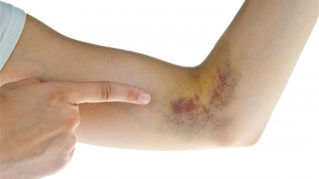 bai-viet/cach-giam-sung-khi-bi-va-dap-hieu-qua-va-nhanh-chong.html