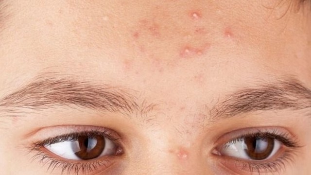 bai-viet/cach-het-mun-o-tran-hieu-qua-chuan-y-khoa.html