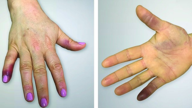 bai-viet/cach-lam-tan-mau-bam-o-ngon-tay.html