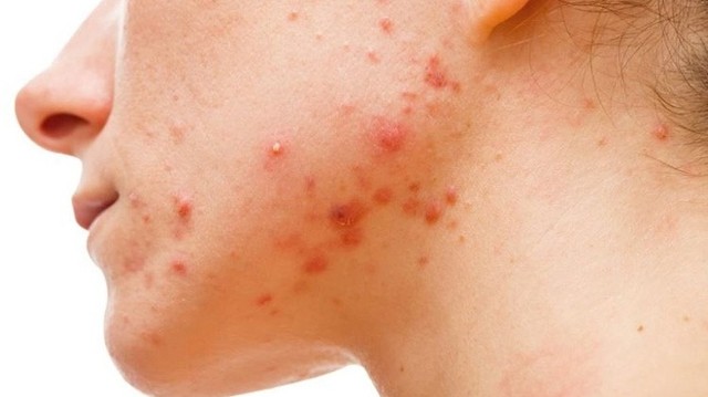 bai-viet/cach-lam-xep-mun-sung-do-sau-1-dem-ban-da-biet-chua.html