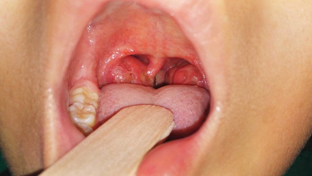 bai-viet/cach-lay-soi-amidan-nhung-luu-y-can-biet.html