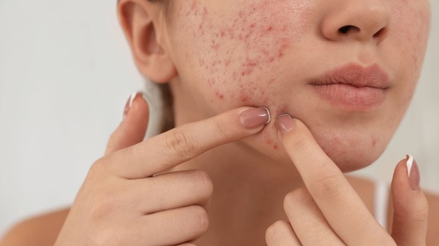 bai-viet/cach-nan-mun-khong-bi-tham-bi-mat-nghe-nghiep-cua-nhan-vien-spa.html