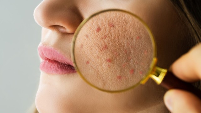 bai-viet/cach-ngan-ngua-mun-10-nguoi-ap-dung-thanh-cong-ca-10.html