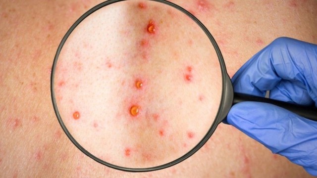 bai-viet/dau-hieu-benh-giang-mai-benh-giang-mai-o-nam-gioi-qua-cac-giai-doan.html