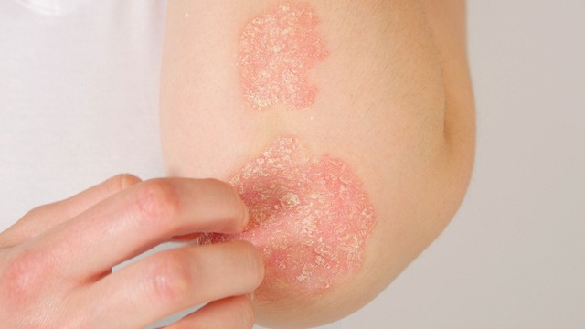 bai-viet/cach-phan-biet-cac-loai-benh-cham-khac-nhau.html