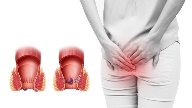 bai-viet/cach-phan-biet-polyp-hau-mon-va-tri-ma-ban-can-biet.html