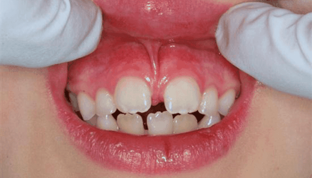 bai-viet/cach-so-cuu-khi-be-bi-dut-day-thang-moi-tren-khi-nao-tre-can-phau-thuat-63747.html