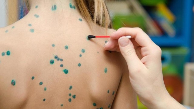 bai-viet/cach-tay-thuoc-xanh-methylen-tren-da-va-cach-bao-quan-thuoc-cho-hieu-qua.html