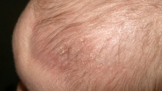 bai-viet/cach-tri-benh-choc-dau-o-tre-em-61306.html