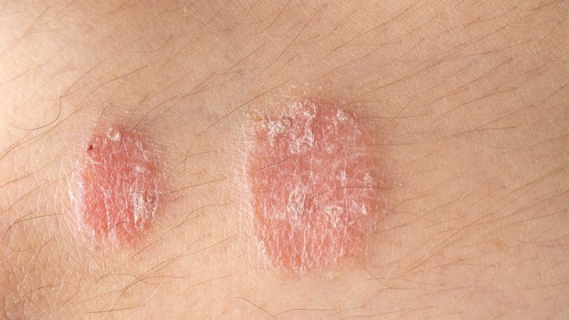 bai-viet/cach-tri-benh-vay-nen-tai-nha-bang-cac-loai-nuoc-la-62242.html