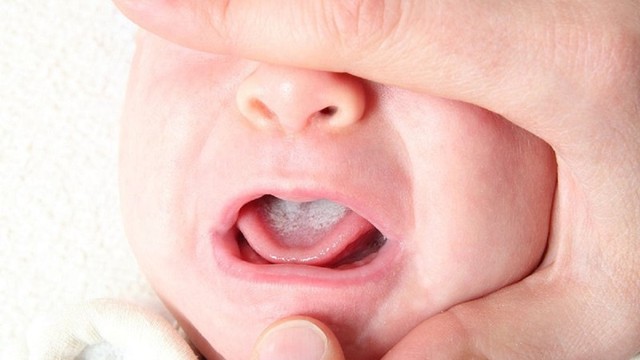 bai-viet/cach-tri-dut-diem-nam-mieng-o-tre-so-sinh-56172.html