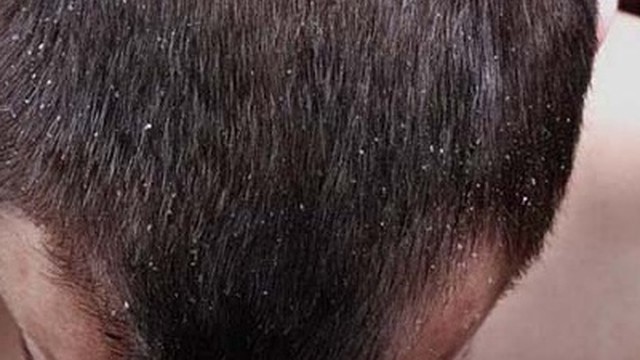 bai-viet/cach-tri-gau-hieu-qua-cho-nam-va-mot-so-luu-y-59368.html