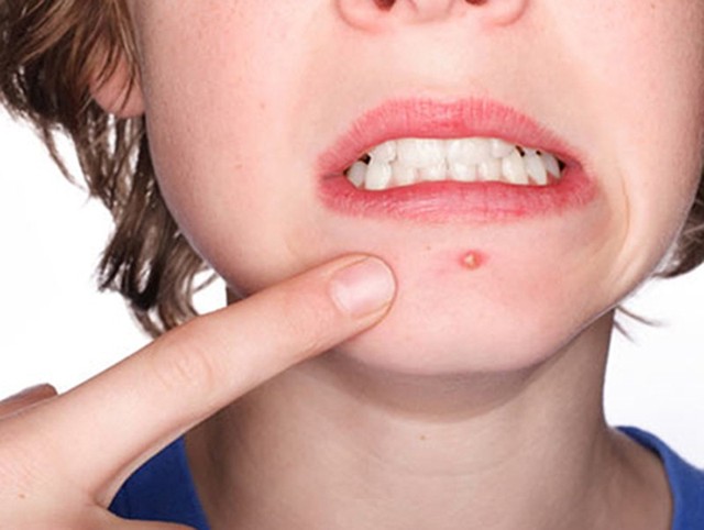 bai-viet/cach-tri-mun-boc-bang-toi-hieu-qua-tiet-kiem-thoi-gian-danh-cho-cac-chi-em-10443.html