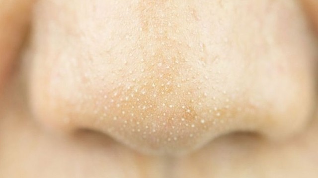 bai-viet/cach-tri-mun-cam-hieu-qua-khong-phai-ai-cung-biet-71254.html