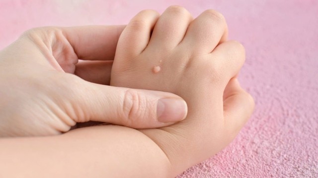 bai-viet/cach-tri-mun-coc-dan-gian-tai-nha-nhieu-nguoi-chua-biet-60887.html