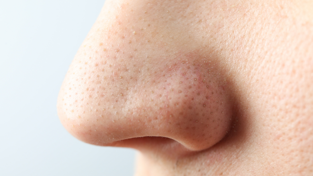 bai-viet/cach-tri-mun-dau-den-o-mui-tai-nha-de-ap-dung.html