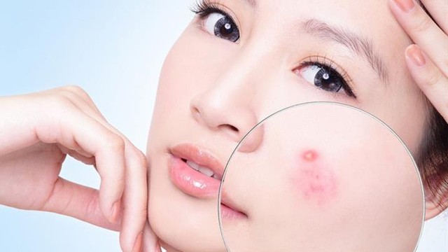 bai-viet/cach-tri-mun-nhot-o-mat-va-nhung-luu-y-khi-dieu-tri-tai-nha-72412.html