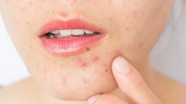 bai-viet/cach-tri-mun-noi-tiet-o-cam-hieu-qua.html