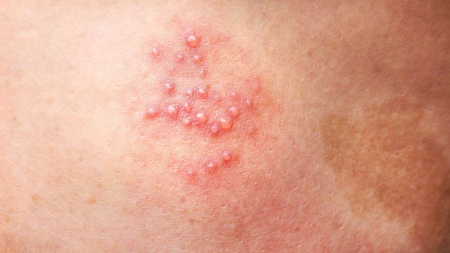 bai-viet/cach-tri-mun-rop-sinh-duc-tai-nha-co-hieu-qua-khong.html