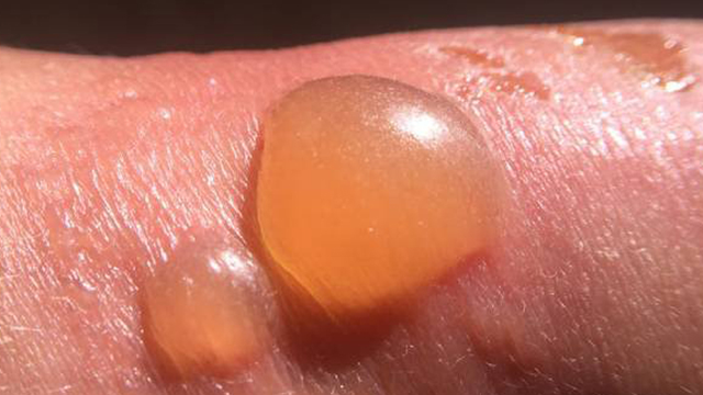 bai-viet/cach-tri-seo-bong-tu-nguyen-lieu-thien-nhien-lanh-tinh-61839.html