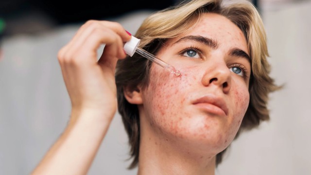 bai-viet/cach-tri-tham-mun-nang-hieu-qua-an-toan-cho-da.html