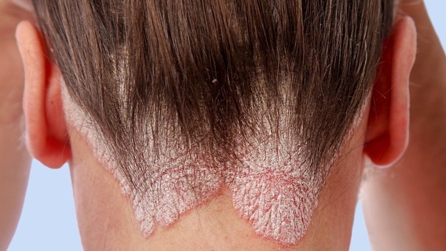 bai-viet/cach-tri-vay-nen-da-dau-tai-nha-va-nhung-sai-lam-can-tranh.html