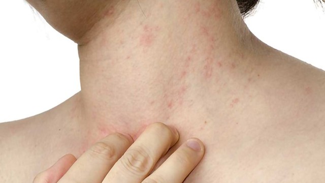 bai-viet/cach-xu-ly-khi-bi-noi-mun-trung-ca-boc-o-co-53612.html