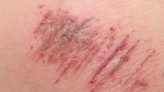 bai-viet/cach-xu-ly-vet-tray-xuoc-da-tai-nha-58145.html