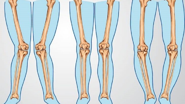 bai-viet/cai-thien-tinh-trang-chan-cong-ra-sau-bang-cach-nao.html