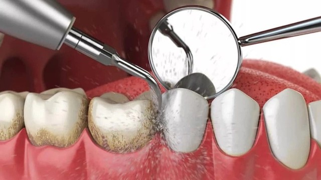 bai-viet/cao-rang-la-gi-phan-do-cao-rang-cach-loai-bo-va-phong-ngua-cao-rang.html