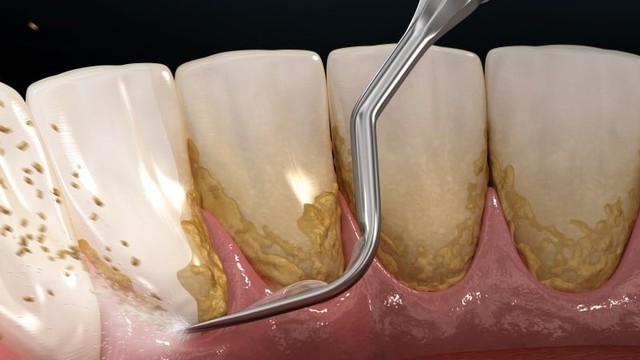 bai-viet/cao-voi-rang-co-anh-huong-gi-khong-loi-ich-cua-viec-cao-voi-rang.html