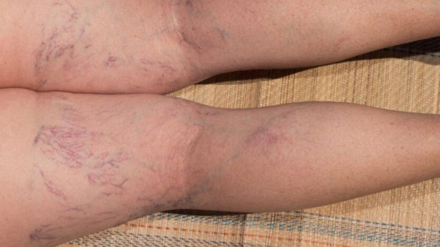 Cấp độ suy giãn tĩnh mạch: Cách nhận biết, phân loại và hướng xử lý phù hợp