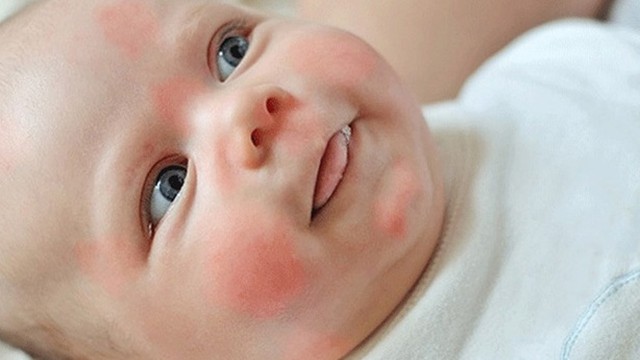 bai-viet/cap-nhap-danh-sach-cac-loai-thuoc-di-ung-da-cho-tre-em-60797.html