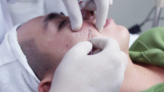 bai-viet/cat-day-seo-kieng-an-gi-de-nhanh-phuc-hoi-cach-cham-soc-da-sau-cat-day-seo.html